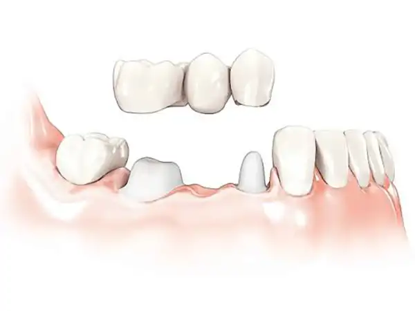 Mondzorg arkel kronen en bruggen
