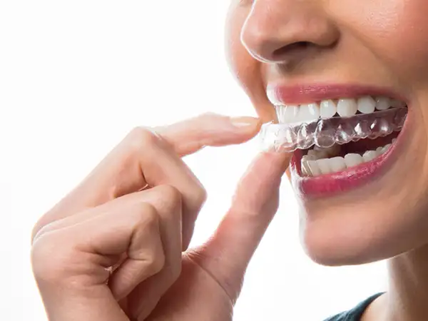 Mondzorg arkel tanden bleken